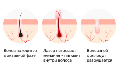 Photo of Принцип действия и основные преимущества лазерной эпиляции