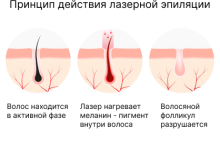 Photo of Принцип действия и основные механизмы лазерной эпиляции