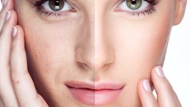 Photo of Кислотные эксфолианты в борьбе с акне